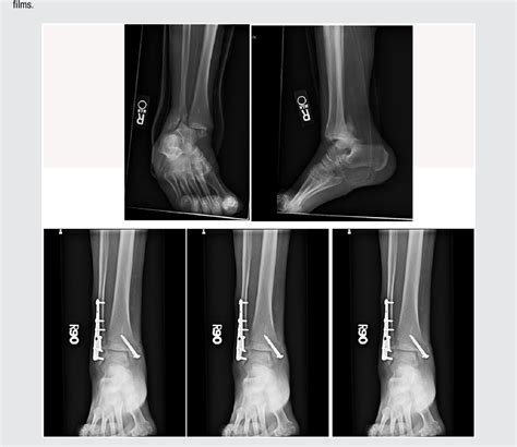 A fractured <strong>ankle</strong> can range from: A simple break in one bone, which may not stop you from walking, to. . Right ankle fracture icd 10